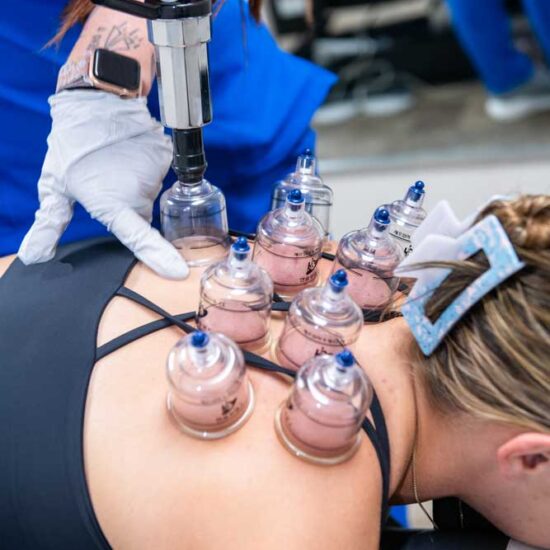 cupping services