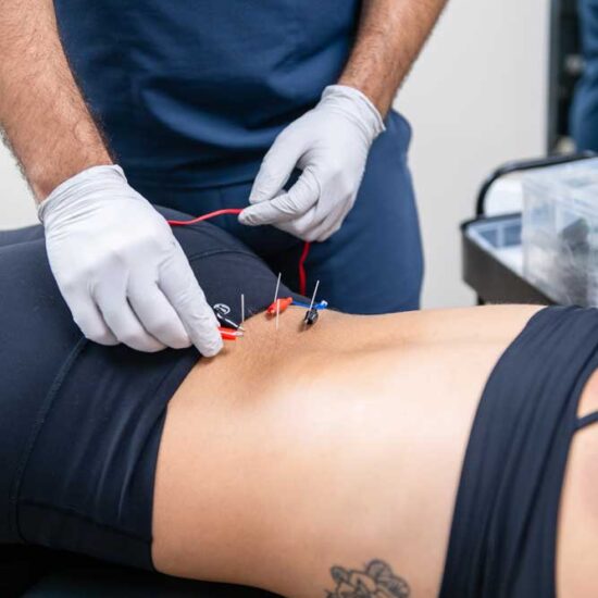 dry needling