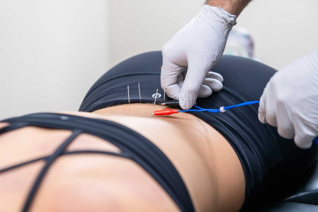 dry needling services