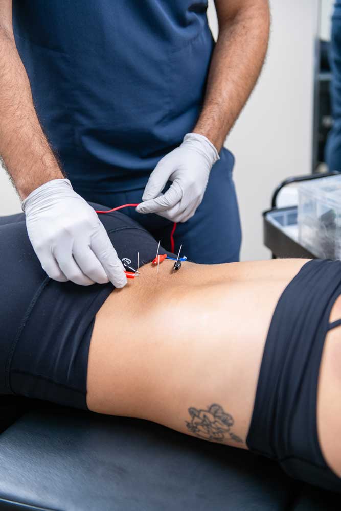 dry needling